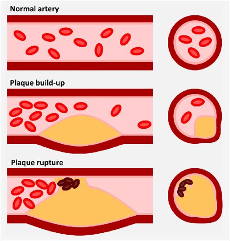 picture of atherosclerotic plaques.